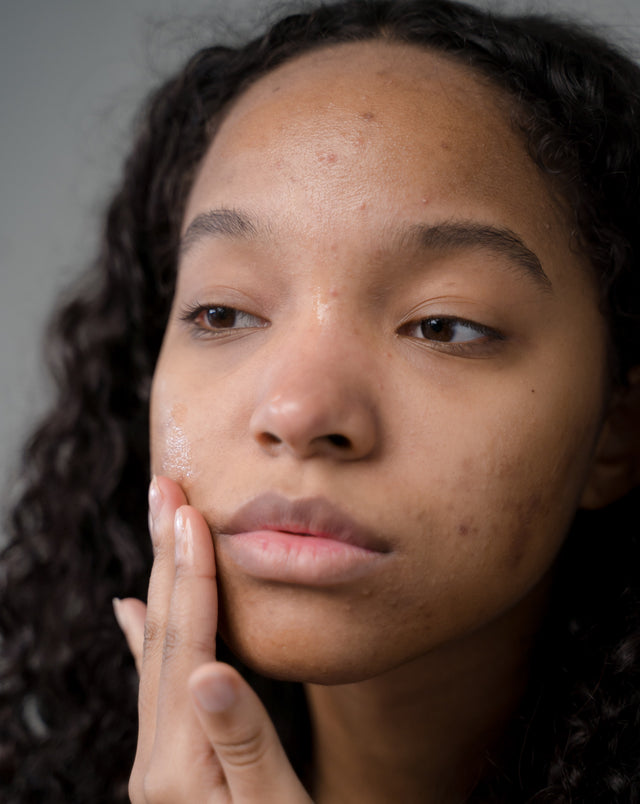 How to Treat Acne & Pimples: Effective Tips for Clearer Skin